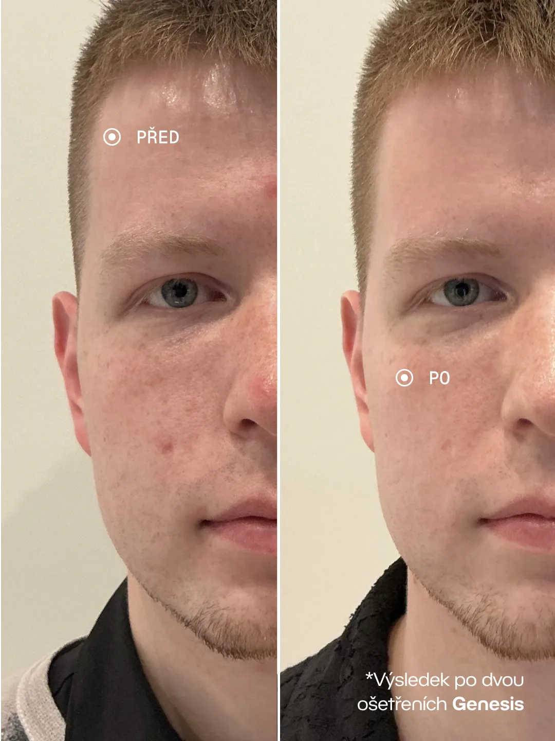 Před a po – Genesis · 2 ošetření, Akné a zarudnutí