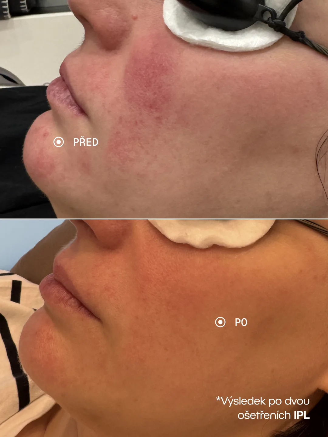 IPL – IPL · 2 ošetření, Zarudnutí a cévky