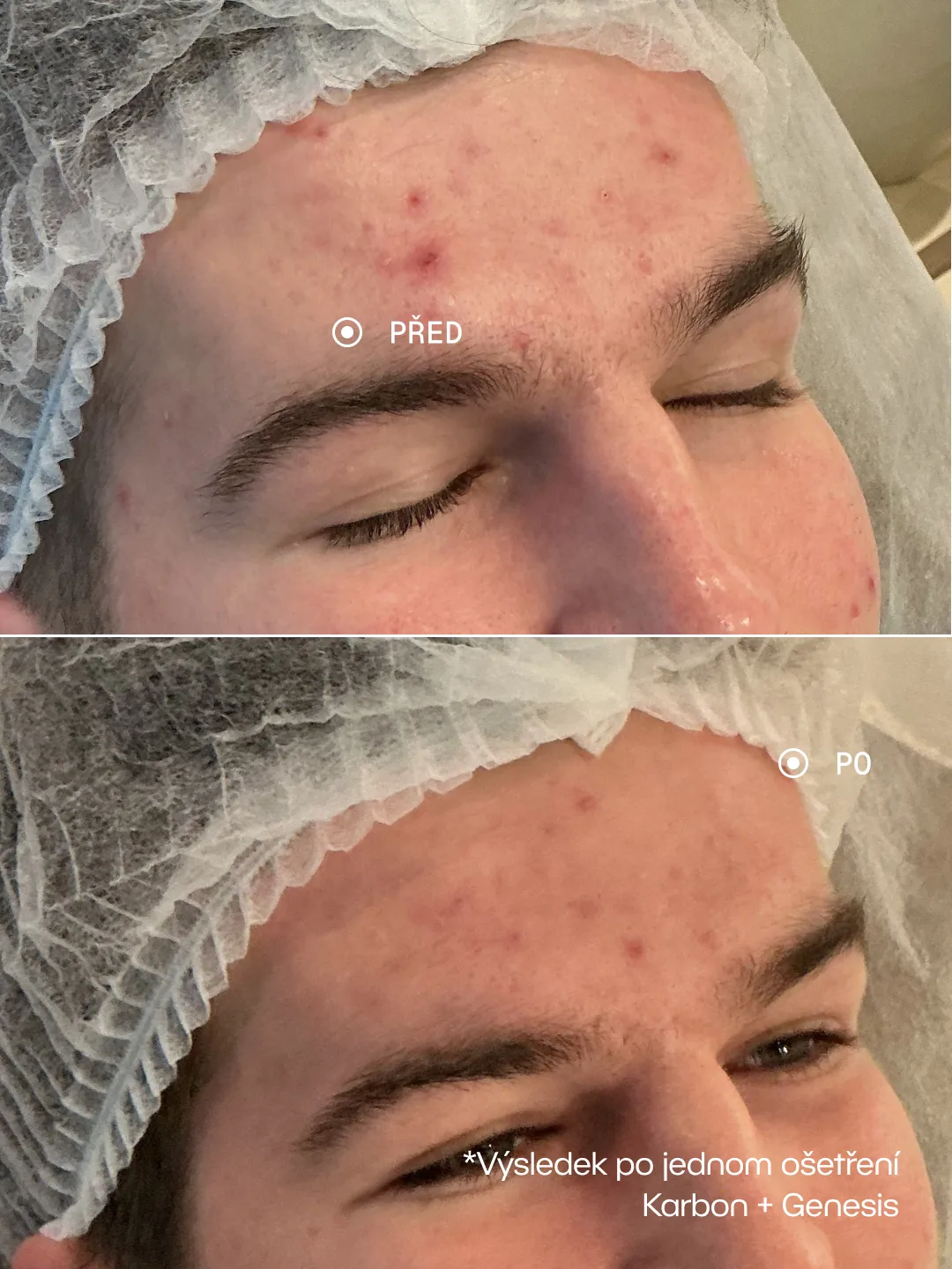 Karbonový peeling + Genesis – Karbon + Genesis · 1 ošetření, Akné na čele