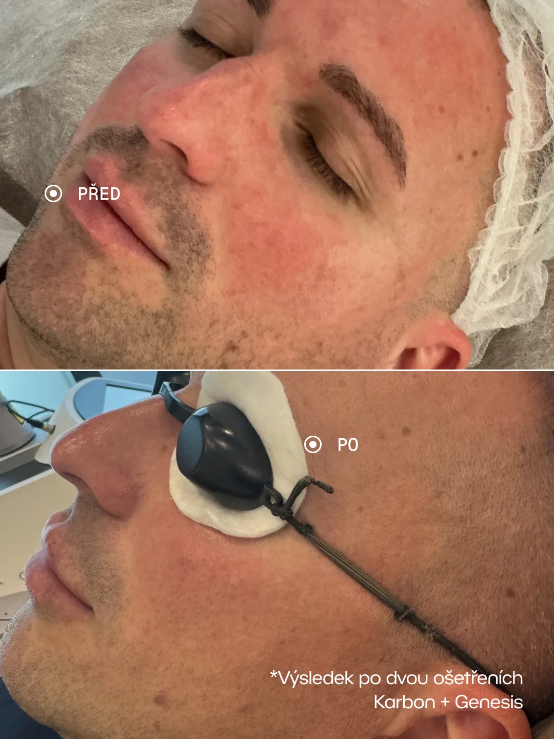 Karbonový peeling + Genesis – Karbon + Genesis · 2 ošetření, Zarudnutí a podráždění