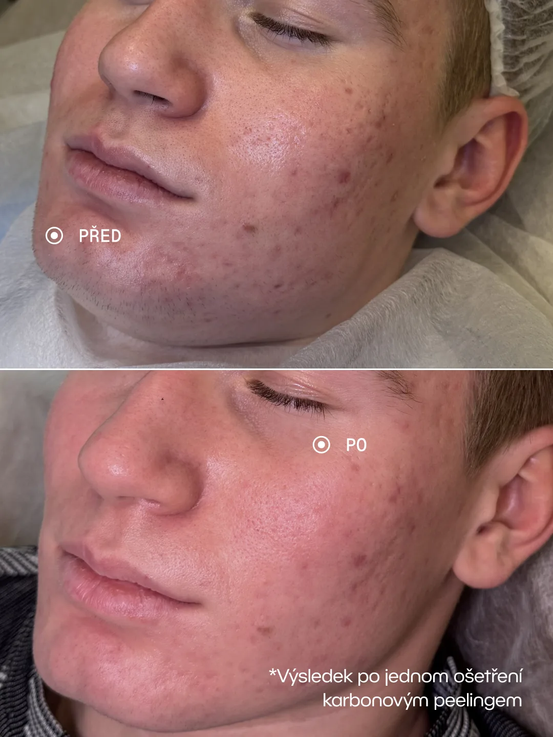 Karbonový peeling – Karbonový peeling · 1 ošetření, Akné a rozšířené póry