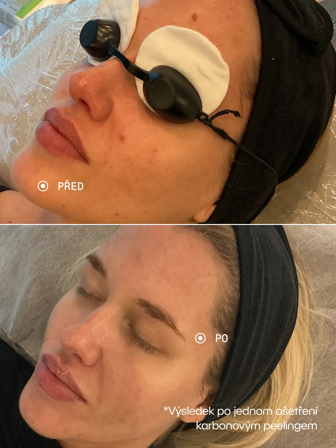 Před a po – Karbonový peeling · 1 ošetření, Okamžité rozjasnění