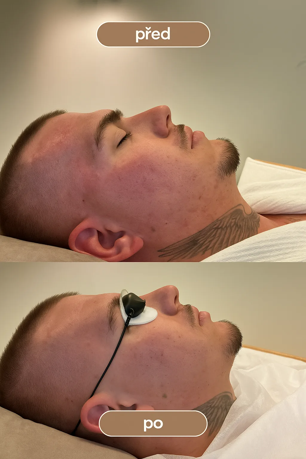 Karbonový peeling + Genesis – Výsledek před a po