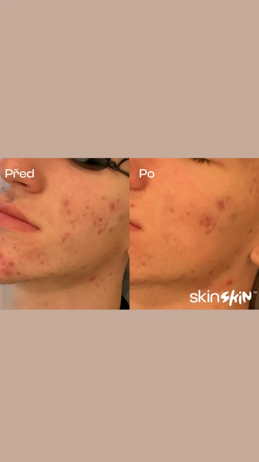 Karbonový peeling – Výsledek před a po