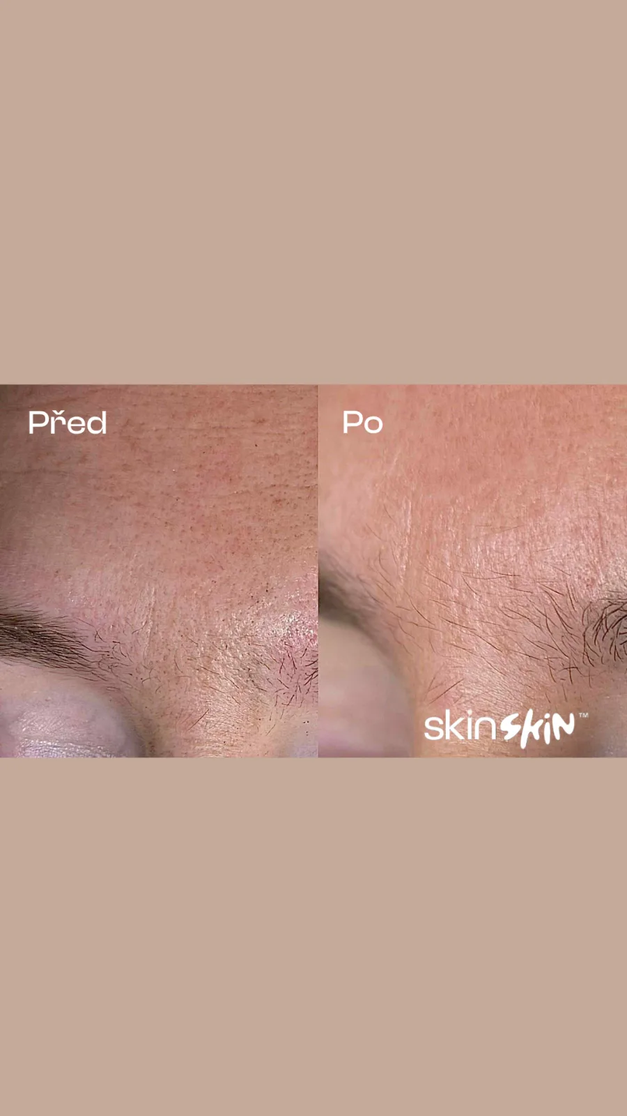 Karbonový peeling – Výsledek před a po