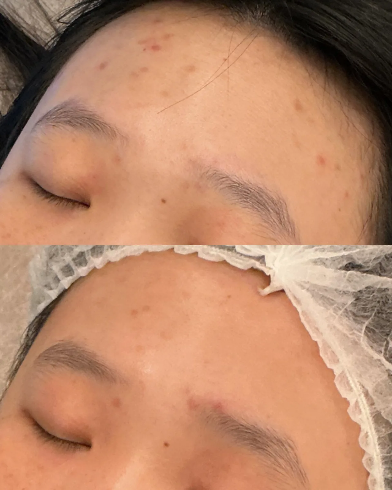 Karbonový peeling – Výsledek před a po