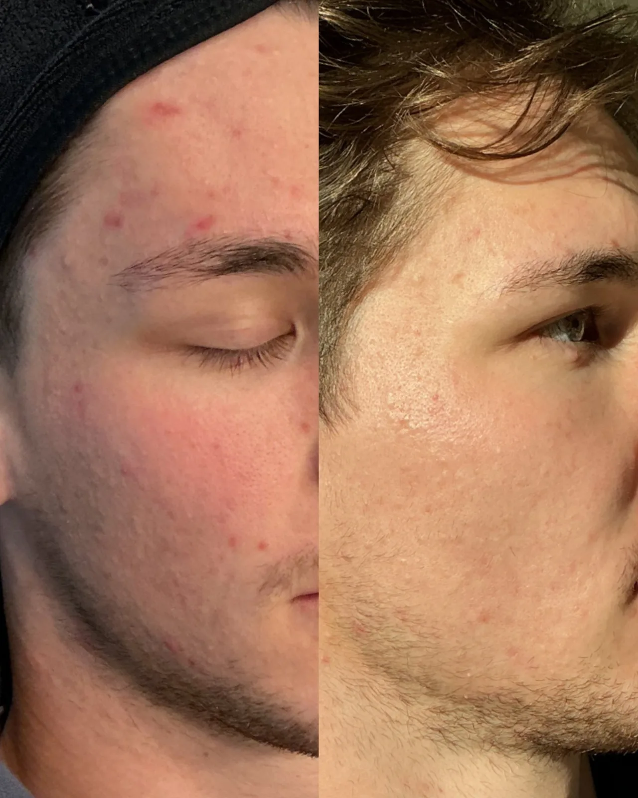 Karbonový peeling + Genesis – Výsledek před a po