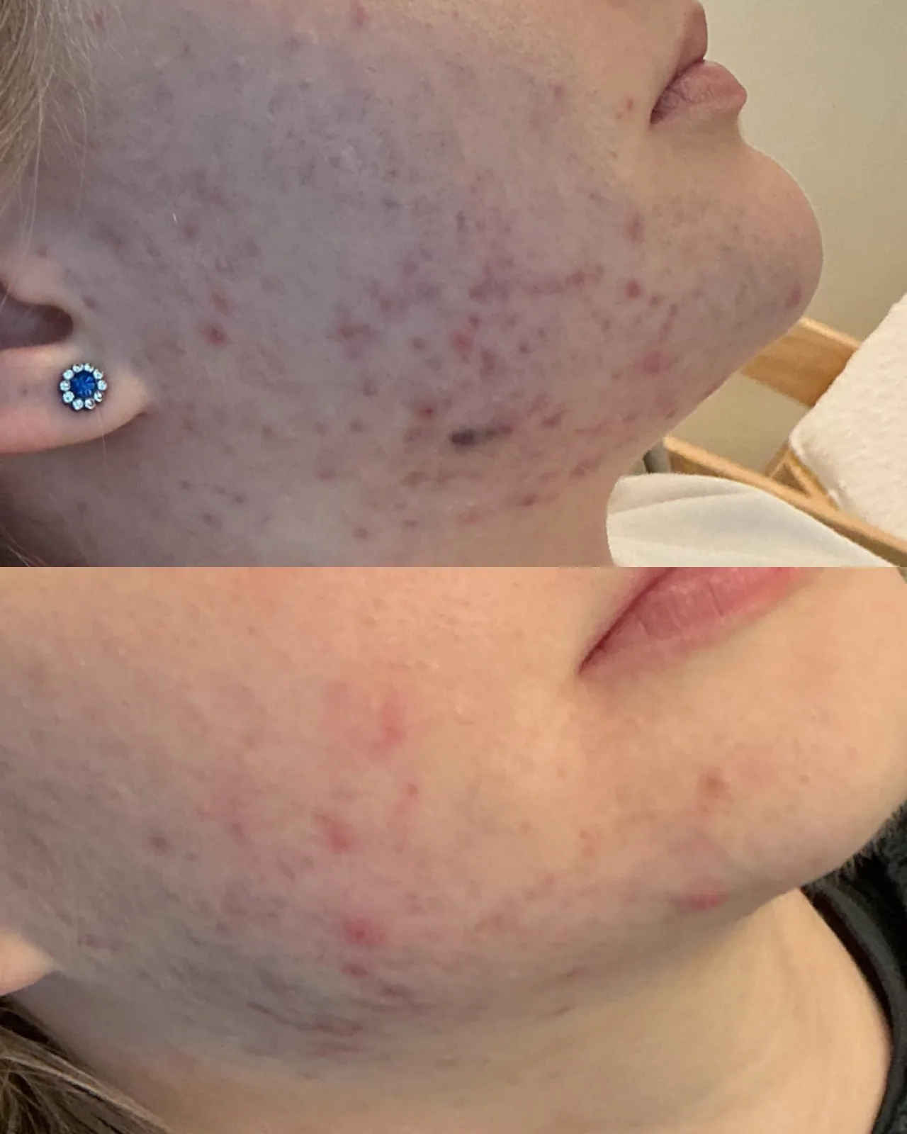 Karbonový peeling + Genesis – Výsledek před a po