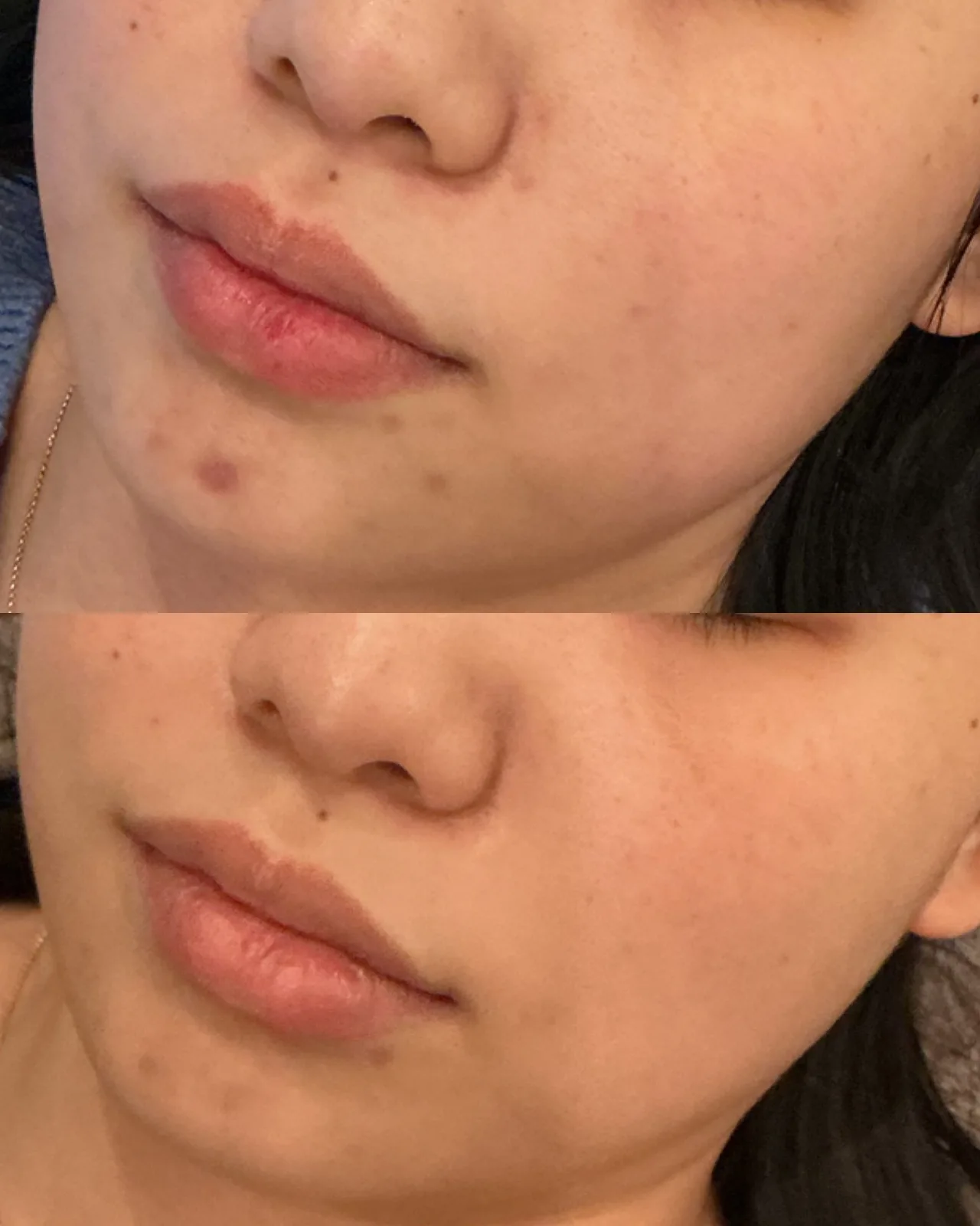Karbonový peeling + Genesis – Výsledek před a po