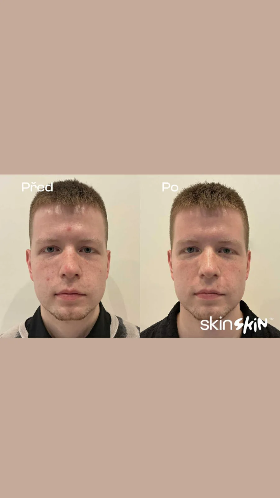 Laser Genesis – Výsledek před a po